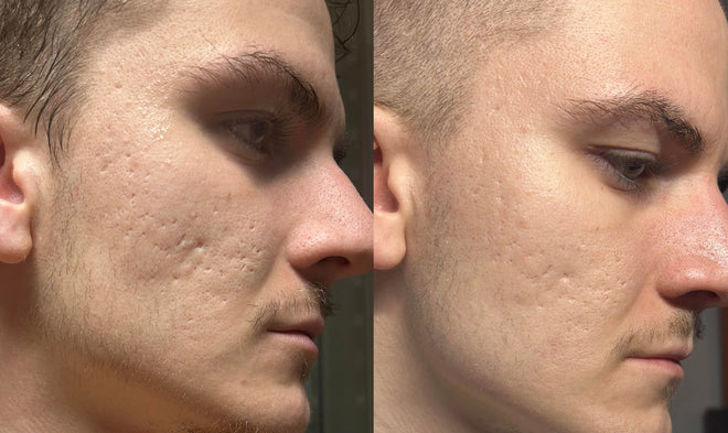 Aknéhegek fentről jövő fényben