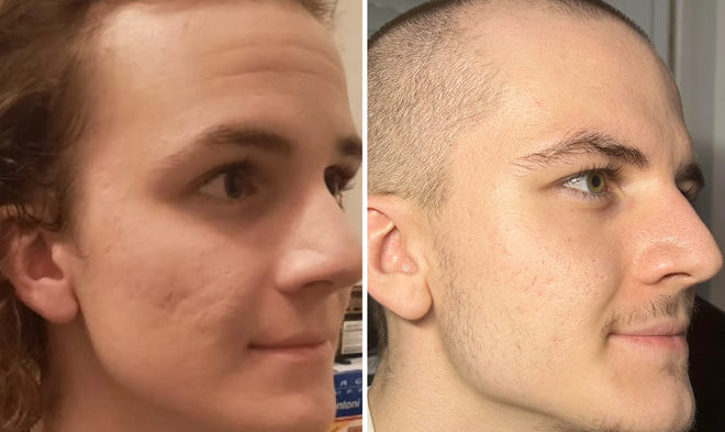 Homlokráncok mélysége