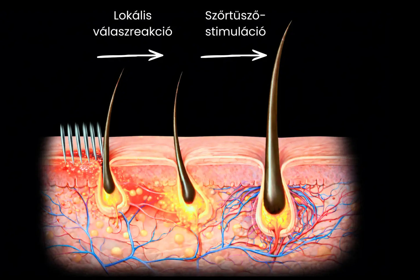 4 db Dermastamp (1 mm)