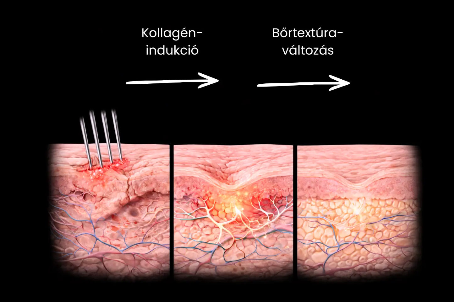 4 db Dermastamp (1 mm)