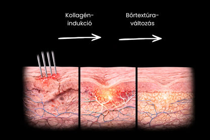 4 db Dermastamp (1 mm)